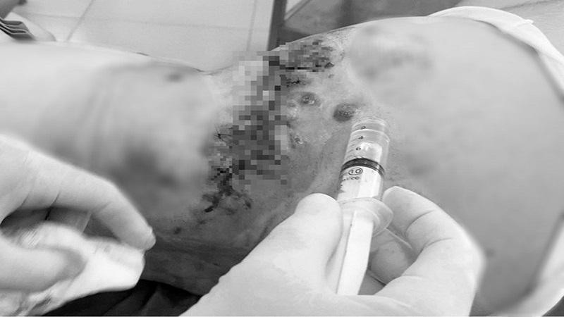 Bệnh nhân A. nhập viện trong tình trạng bị hở vết khâu vùng hông 2 bên và vết thương phần mềm thành bụng dưới rốn. Ảnh: BVCC