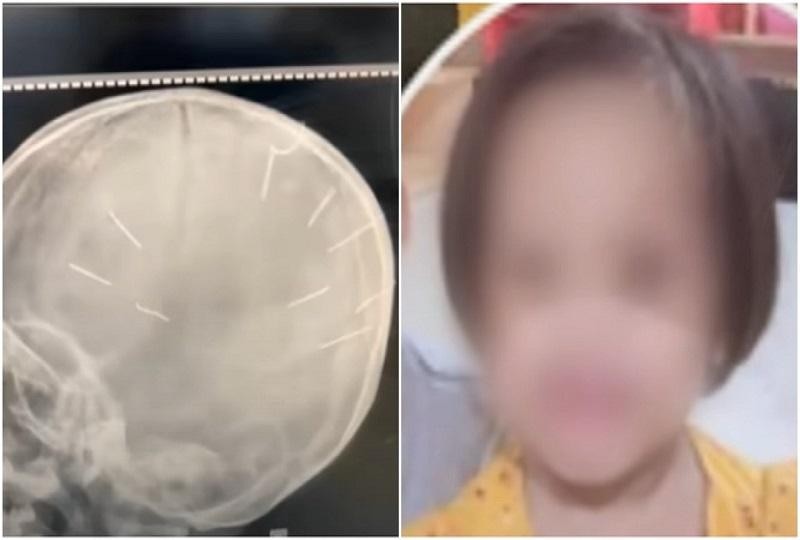 Bé gái 3 tuổi nghi bị bạo hành với 9 chiếc đinh trong hộp sọ. Ảnh chụp màn hình video