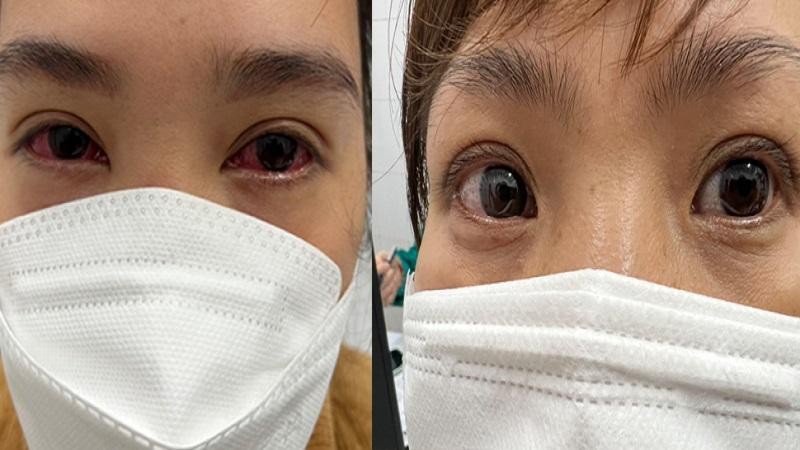 Bệnh nhân bị viêm kết mạc mắt hậu COVID-19. Ảnh: BVCC