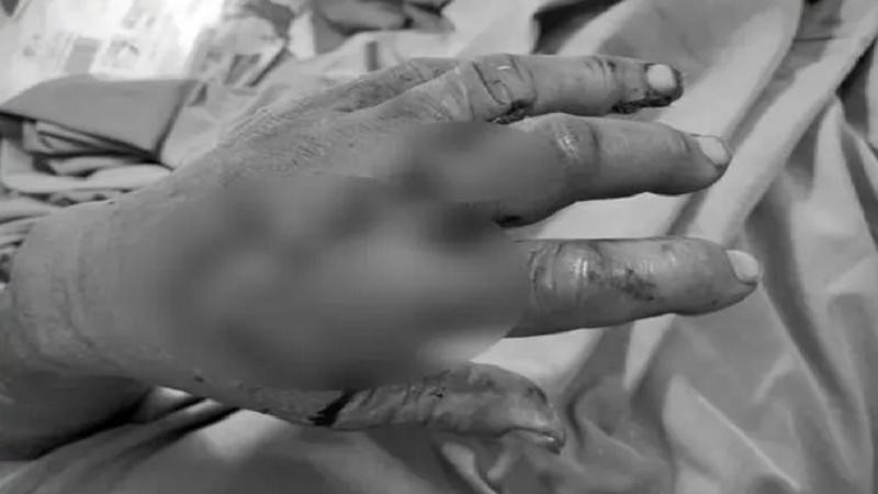 Bàn tay của bệnh nhân sau khi được các bác sĩ nối lại. Ảnh: BVCC