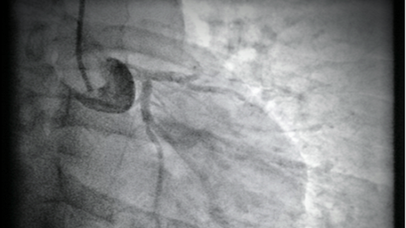 Hình ảnh mạch vành bị tắc của bệnh nhân. Ảnh: BVCC