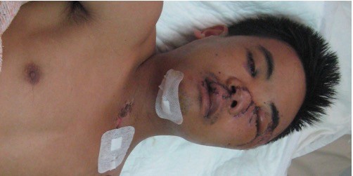 Khuôn mặt bệnh nhân V sau khi được phẩu thuật (ảnh Duy Hải - Bệnh viện TW Huế)