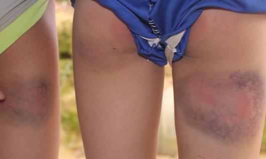 Vết bầm tím trên đùi một học sinh vì bị đánh.