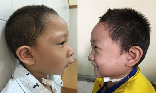Bệnh nhân 5 tuổi đã bình phục sau 2 tháng phẫu thuật