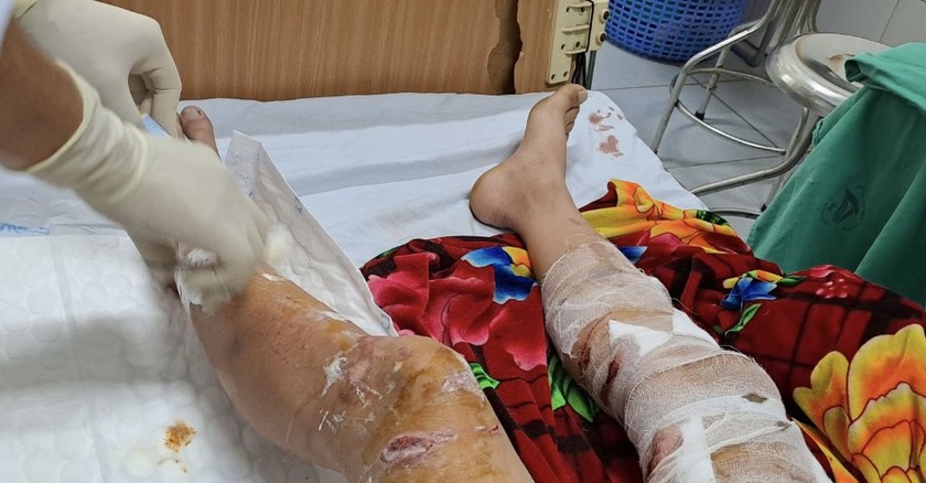 Lào cai: Một nạn nhân bị chó thả rông cắn gây thương tích nặng 