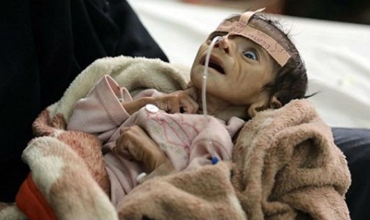 Nhiều trẻ em ở Yemen chết vì suy dinh dưỡng